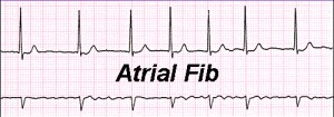 ECG image of AF