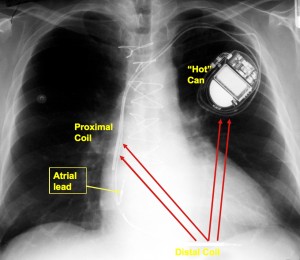 ICD CXR PIC