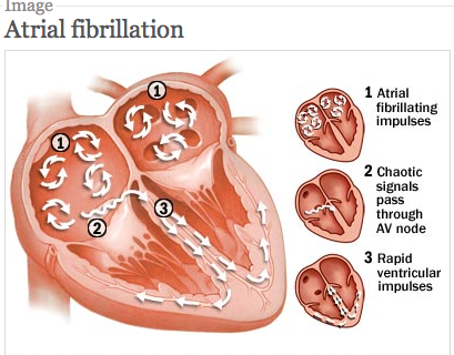 What is AFib?