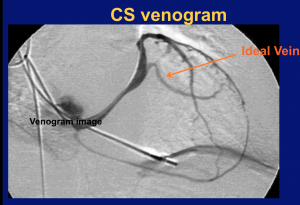 CRT with Coronary Sinus Venogram