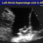 Clot in LA appendage