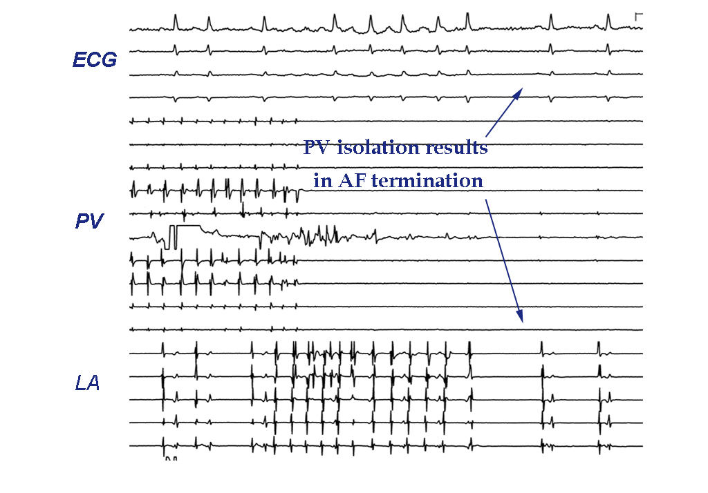 What Are The Risks Of Ablation Procedure