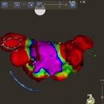 AF ablation with pulmonary vein isolation
