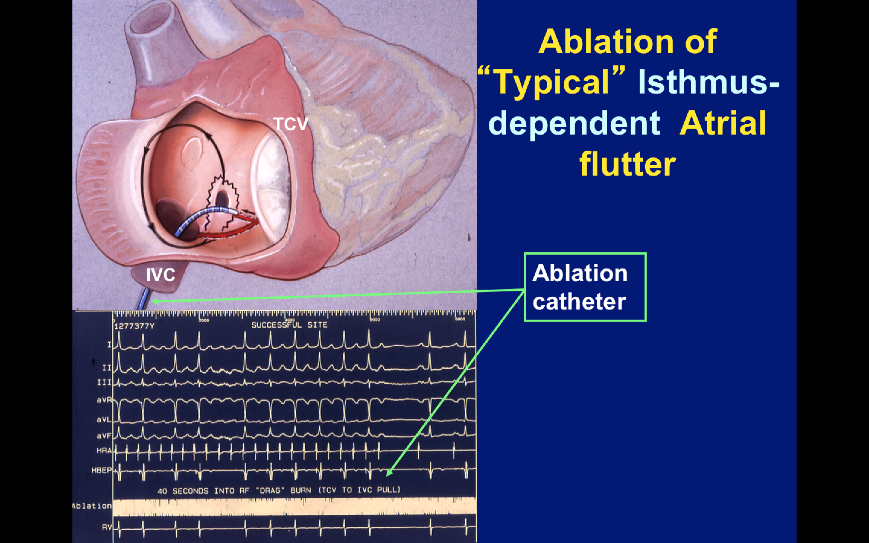 atrial flutter atrial flutter