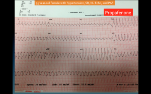 1:1 Atrial Flutter due to propafenone